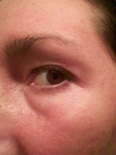 Mí mắt sưng nặng, mờ mắt, xuất hiện bọng mắt và đau đầu sau khi tiêm botox xóa nếp nhăn trán?
