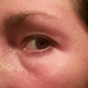 Mí mắt sưng nặng, mờ mắt, xuất hiện bọng mắt và đau đầu sau khi tiêm botox xóa nếp nhăn trán?