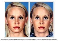Teo cơ thái dương sau lần tiêm botox xóa nếp chân chim đầu tiên?
