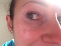 Có phải mỡ dưới mắt tôi phình ra như này là do botox không?