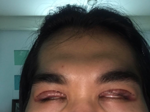 Sau khi cắt mí thì nhắm mắt bị trợn