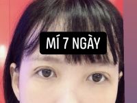Mí cắt bị sưng sau 1 tháng