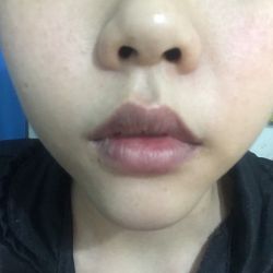 Độn cẰm bị đau nhức