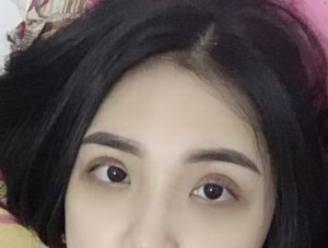 Sau khi cắt mí xong thì khoảng bao lâu là phù hợp để mở góc mắt trong ?