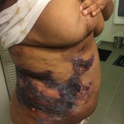 Phồng rộp ở vùng bầm tím sau hút mỡ gần 1 tháng thì có bình thường không?