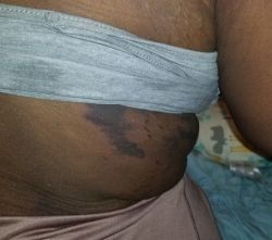 Đây là bỏng hay bầm tím sau hút mỡ - tôi phải chữa như thế nào?