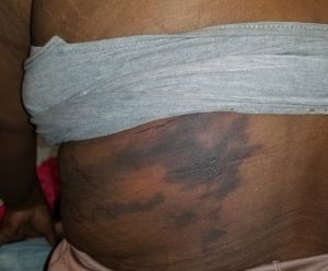 Đây là bỏng hay bầm tím sau hút mỡ - tôi phải chữa như thế nào?