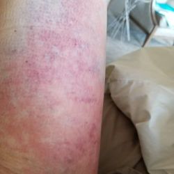 Bầm tím và đỏ rát ở lưng và má đùi trong sau hút mỡ - có bình thường không?