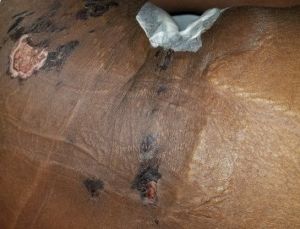 Đây là bỏng hay bầm tím sau hút mỡ - tôi phải chữa như thế nào?