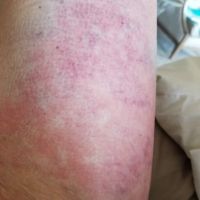 Bầm tím và đỏ rát ở lưng và má đùi trong sau hút mỡ - có bình thường không?