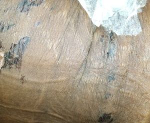 Đây là bỏng hay bầm tím sau hút mỡ - tôi phải chữa như thế nào?