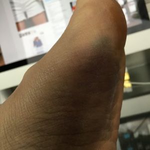 Bàn chân/cổ chân sưng và bầm tím sau hút mỡ má đùi trong/ngoài 13 ngày, gân chân căng như sắp đứt - có đáng lo?