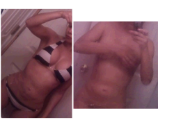 Là do bụng tôi sưng hay là do tôi tăng cân trở lại sau hút mỡ ba tuần?