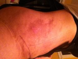 Bầm tím và phồng rộp sau hút mỡ 5 tuần?