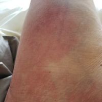 Bầm tím và đỏ rát ở lưng và má đùi trong sau hút mỡ - có bình thường không?
