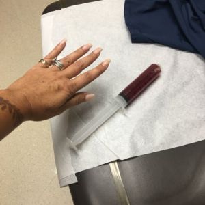 Vẫn bị bầm tím, vùng xương ức rất cứng và tôi vẫn bị đau kinh khủng sau hút mỡ 5 tuần!