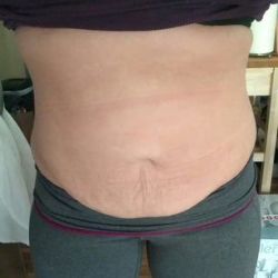 Làm sao để biết bụng lồi là do sưng nề hay do mỡ còn sót lại – dấu hiệu nhận biết là gì?