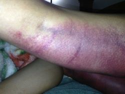 Bầm đỏ có phải hiện tượng bình thường sau tỉa mỡ trong quá trình hút mỡ?