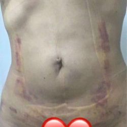 Có phải tấm ép bụng/lưng và miếng xốp lót bên dưới khiến tôi bị tầm tím nhiều hơn sau hút mỡ không?