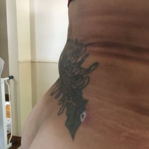 Vẫn bị bầm tím, vùng xương ức rất cứng và tôi vẫn bị đau kinh khủng sau hút mỡ 5 tuần!