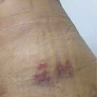 Có phải tấm ép bụng/lưng và miếng xốp lót bên dưới khiến tôi bị tầm tím nhiều hơn sau hút mỡ không? Có phải tấm ép bụng/lưng và miếng xốp lót bên dưới khiến tôi bị tầm tím nhiều hơn sau hút mỡ không?