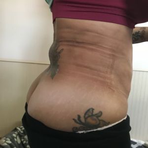 Vẫn bị bầm tím, vùng xương ức rất cứng và tôi vẫn bị đau kinh khủng sau hút mỡ 5 tuần!