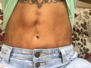 Vẫn bị bầm tím, vùng xương ức rất cứng và tôi vẫn bị đau kinh khủng sau hút mỡ 5 tuần!