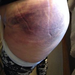 Hút mỡ ở bụng và ụ hông, nhưng hông lại bị bầm tím nặng và sưng – bình thường hay không?