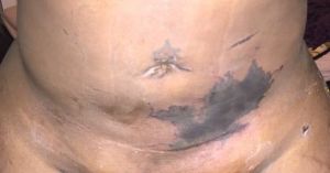 Tôi đã hút mỡ hai tuần trước. Trong ảnh là vùng bầm tím trên bụng. Trông như hoại tử da. Tôi nên làm gì?