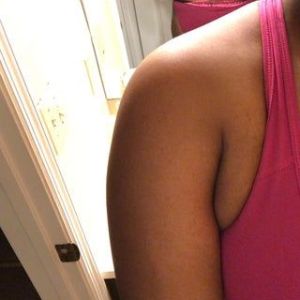 Tôi cao 1m73, nặng 90,7 kg, đã có 1 con. Tôi có phù hợp làm hút mỡ bụng/lườn không?