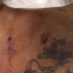 Bỏng do hút mỡ - tôi phải chữa như thế nào?