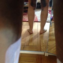 Bầm tím nặng sau hút mỡ má đùi trong