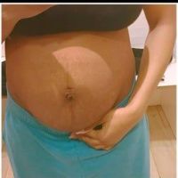 Tôi có thể hút mỡ bụng nếu bị tách cơ thẳng bụng hay không? Tôi có thể hút mỡ bụng nếu bị tách cơ thẳng bụng hay không?