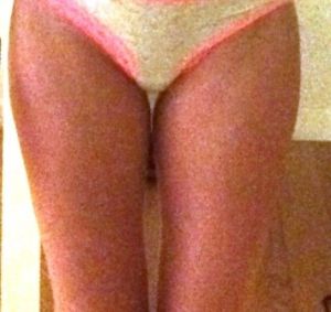 Đau đớn và bầm tím nặng sau hút mỡ đùi – có phải đang có vấn đề gì không?