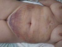 Bầm tím và sưng nề nhiều sau hút mỡ bụng - liệu đã thấy được kết quả cuối chưa?