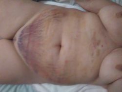 Bầm tím và sưng nề nhiều sau hút mỡ bụng - liệu đã thấy được kết quả cuối chưa?