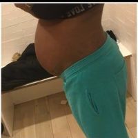 Tôi có thể hút mỡ bụng nếu bị tách cơ thẳng bụng hay không? Tôi có thể hút mỡ bụng nếu bị tách cơ thẳng bụng hay không?
