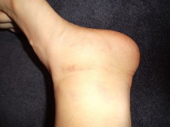 Nổi các vết bầm tím mới và sưng nề thêm ở cổ chân/bàn chân sau hút mỡ hai má đùi 10 ngày trước – đây có phải dấu hiệu xấu không?
