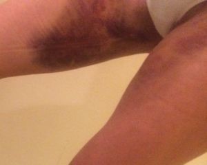 Đau đớn và bầm tím nặng sau hút mỡ đùi – có phải đang có vấn đề gì không?