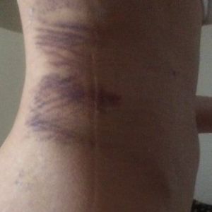 Đau đớn và bầm tím nặng sau hút mỡ đùi – có phải đang có vấn đề gì không?