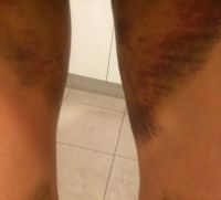 Đau đớn và bầm tím nặng sau hút mỡ đùi – có phải đang có vấn đề gì không?