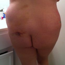 Làm tạo hình thành bụng và hút mỡ ụ hông: vùng bị lõm là do sưng nề bình thường hay do mỡ sót lại?