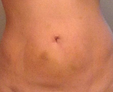 Tôi có nên lo lắng về vết bầm tím nhỏ, cứng hiện diện 13 ngày sau hút mỡ ở bụng không?