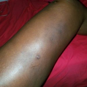 Tôi vẫn còn bị sưng nề, bầm tím, nổi cục lồi lõm, bị cứng và đau sau hút mỡ đùi 6 tuần?