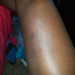 Tôi vẫn còn bị sưng nề, bầm tím, nổi cục lồi lõm, bị cứng và đau sau hút mỡ đùi 6 tuần?