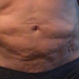 Tôi đã làm hút mỡ được ba tháng mà vẫn sưng thì có bình thường không?