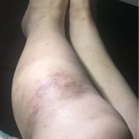 Có phải tôi đã bị tụ máu sau hút mỡ ở chân – có nên đi khám không? Có phải tôi đã bị tụ máu sau hút mỡ ở chân – có nên đi khám không?