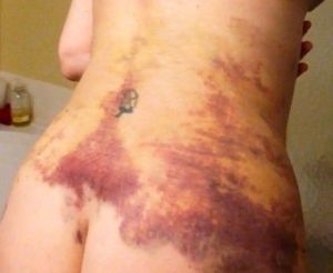 Hút mỡ xong bị đau, bầm tím và cứng bên dưới da - tôi nên làm gì?