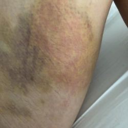 8 ngày sau hút mỡ, vết bầm bị đỏ, ngứa và đau, nhưng bác sĩ bảo vẫn bình thường.