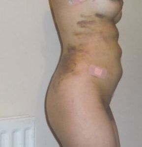 Bụng lồi lõm, lượn sóng và sưng sau phẫu thuật hút mỡ 8 tuần